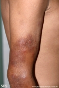 leprosy lepromatous