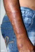 leprosy lepromatous