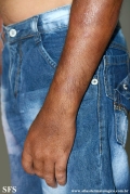 leprosy lepromatous