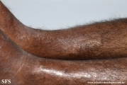 leprosy lepromatous