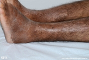 leprosy lepromatous