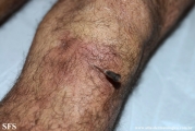 leprosy lepromatous