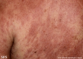 leprosy lepromatous