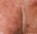leprosy lepromatous