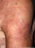 leprosy lepromatous