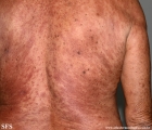 leprosy lepromatous