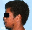 leprosy lepromatous