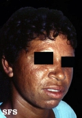 leprosy lepromatous