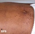 leprosy lepromatous
