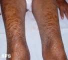 leprosy lepromatous