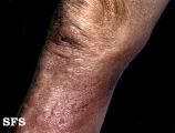 leprosy lepromatous