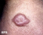 leprosy lepromatous
