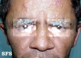 leprosy lepromatous