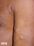 leprosy lepromatous