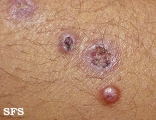 leprosy lepromatous