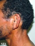 leprosy lepromatous