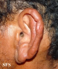 leprosy lepromatous