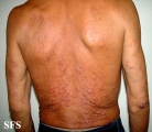 leprosy lepromatous