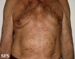 leprosy lepromatous