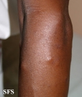 leprosy lepromatous
