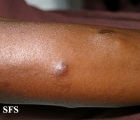 leprosy lepromatous