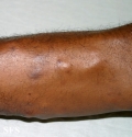leprosy lepromatous