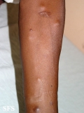leprosy lepromatous