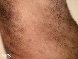 leprosy lepromatous