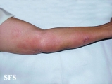 leprosy lepromatous