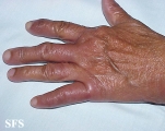 leprosy lepromatous