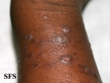 leprosy lepromatous