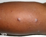leprosy lepromatous