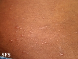 leprosy lepromatous