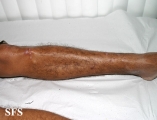 leprosy lepromatous