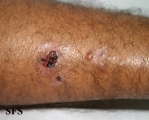 leprosy lepromatous