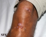 leprosy lepromatous