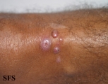 leprosy lepromatous