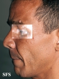 leprosy lepromatous