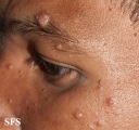 leprosy lepromatous