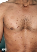 leprosy lepromatous