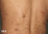 leprosy lepromatous
