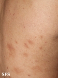 leprosy lepromatous