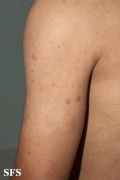 leprosy lepromatous