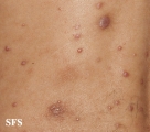 leprosy lepromatous