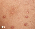 leprosy lepromatous