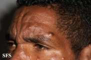 leprosy lepromatous