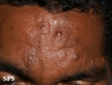 leprosy lepromatous