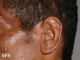leprosy lepromatous