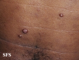 leprosy lepromatous