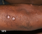 leprosy lepromatous